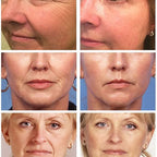 Masker Verminder Fijne Lijntjes