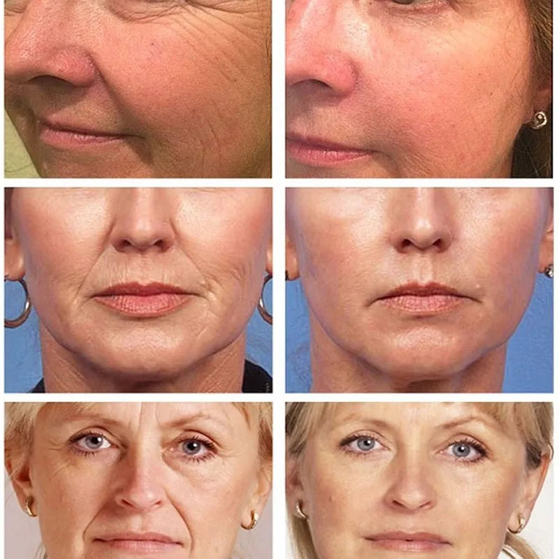 Masker Verminder Fijne Lijntjes